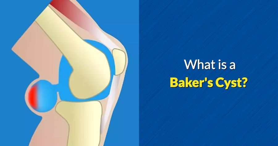 What is a baker's cyst - by OSMO Patch